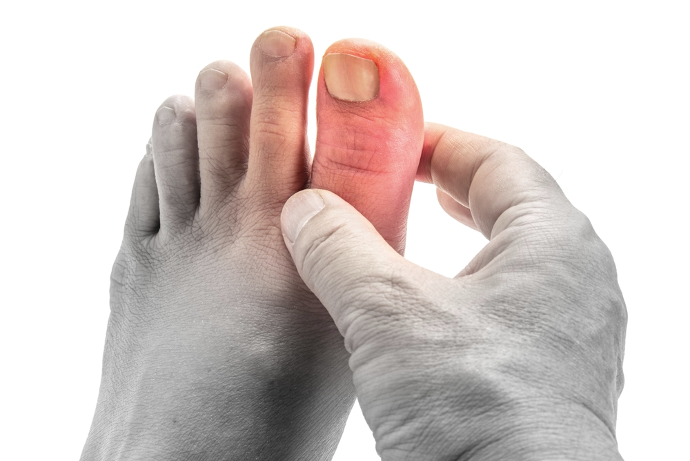 toe of man with gout